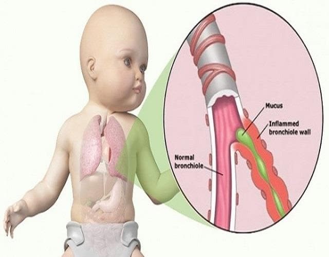 BRONQUIOLITIS AGUDA